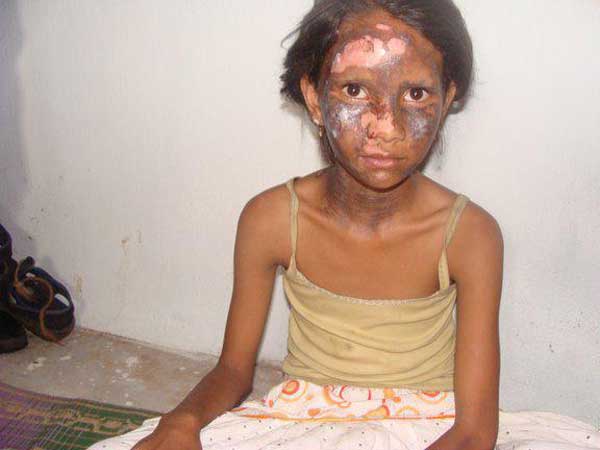 Une petite fille chrétienne brulée et blessée pendant les émeutes d’Orissa en aout 2008 ; des hindouistes avaient jeté une bombe dans la maison où elle habitait. (Source : All India Christian council)