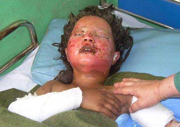 Une des victimes des bombes américaines dans un hôpital à Fararh city. Au moins 147 civils, parmi eux beaucoup de femmes et d’enfants, furent massacrés le 4 mai 2009 lors des frappes aériennes qui touchèrent les villages de Gerani et de Gangabad dans le district de Bala Baluk, Province de Farah, dans l’ouest de l’Afghanistan. Source : Wikimédia commons